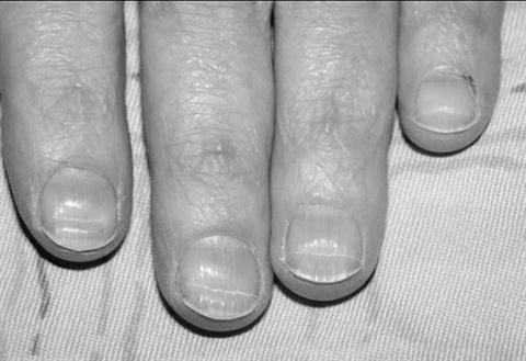 What do horizontal ridges on your fingernails mean? image 4