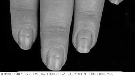 What do horizontal ridges on your fingernails mean? image 6