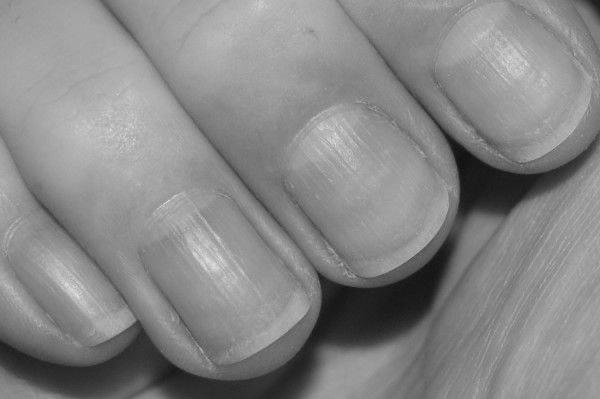 What do horizontal ridges on your fingernails mean? image 8