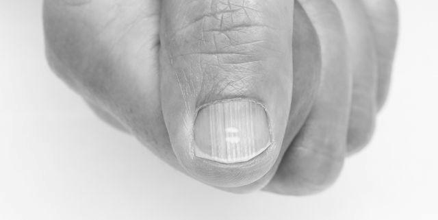 What do horizontal ridges on your fingernails mean? image 15