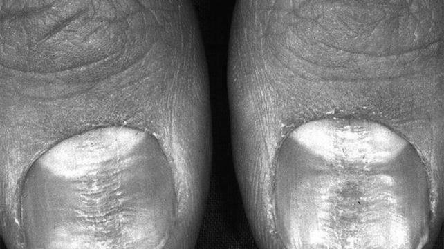 What do horizontal ridges on your fingernails mean? image 16