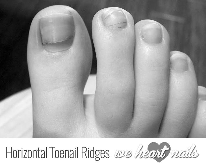 What do horizontal ridges on your fingernails mean? image 17