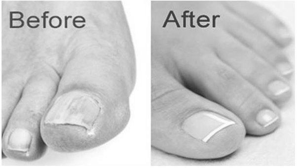 Does Vicks Vaporub really cure toenail fungus? photo 5