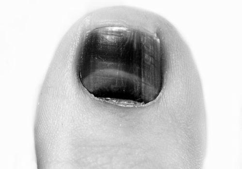 How to safely lance an infection under your nail bed? photo 6