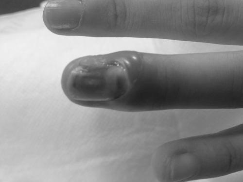 How to safely lance an infection under your nail bed? photo 11