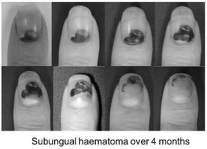 How to safely lance an infection under your nail bed? photo 12