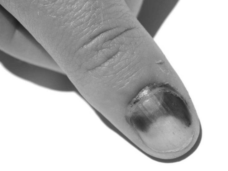How to safely lance an infection under your nail bed? photo 15