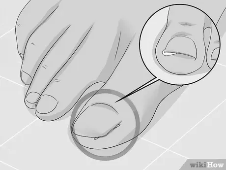 How to safely lance an infection under your nail bed? photo 17