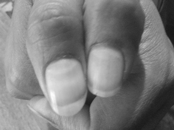 Is it common for guitarists to suffer from receding fingernails? image 14
