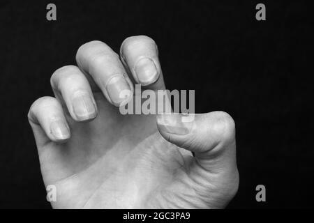 Is it common for guitarists to suffer from receding fingernails? image 15