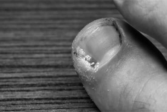 Why does the underside of toenails smell bad? image 9