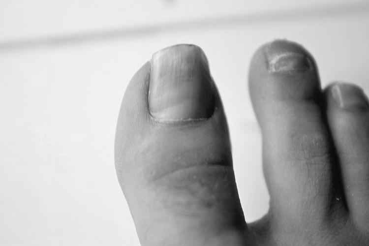 Why does the underside of toenails smell bad? image 18