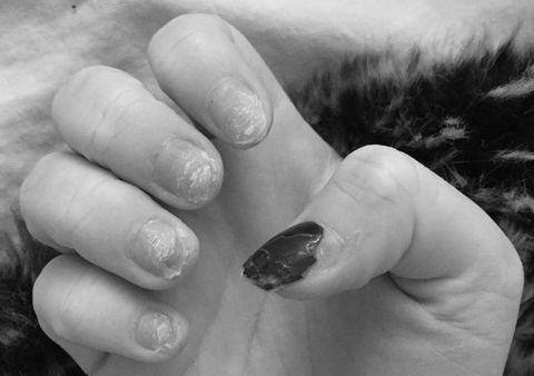 How much damage do acrylics really do to your nails? image 2
