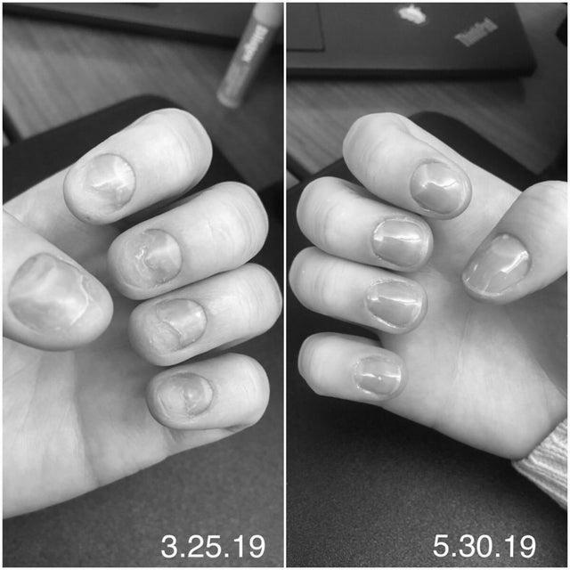 How much damage do acrylics really do to your nails? image 3